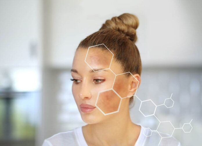 Hyperpigmentation
