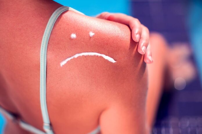 sunburn on holiday
